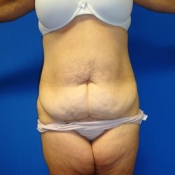 Manhattan abdominoplasty before 12